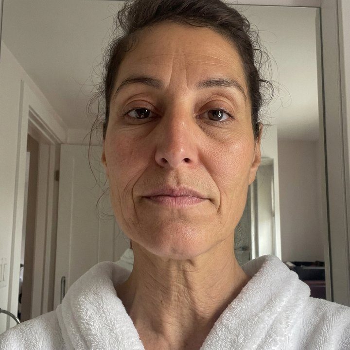 Day 1, tired skin with visible fine lines